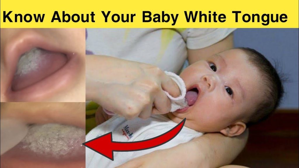 infant white tongue