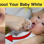 infant white tongue